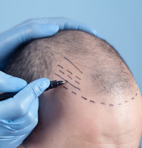 bald spot