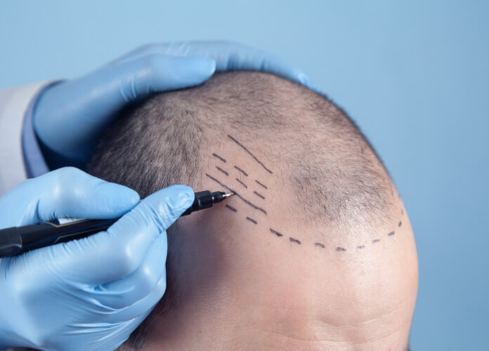 bald spot